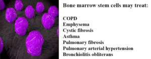 Stem cells may be used for healing damaged lungs
