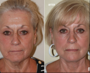 Adipose Stem Cell Therapies are Revolutionizing Plastic Surgery, and Demand is High